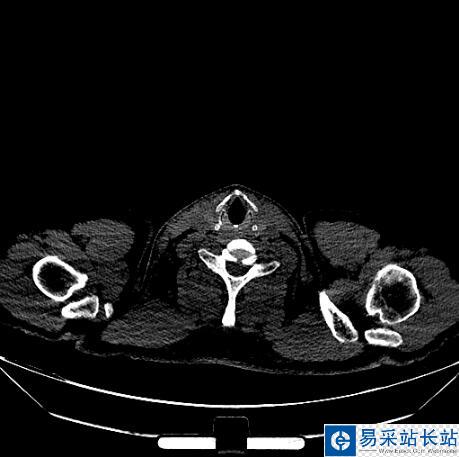python讀取CT醫學圖像