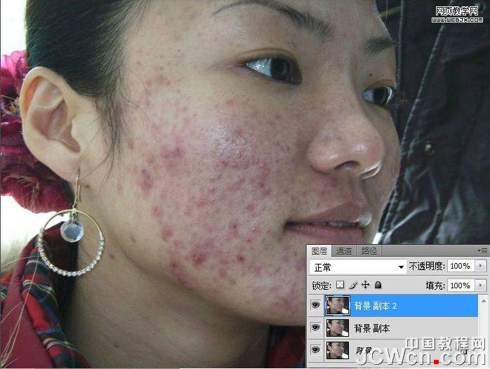 練就網(wǎng)絡(luò)美女 ps完美除痘痘磨皮教程_網(wǎng)頁設(shè)計